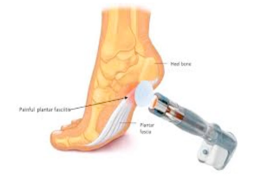 At Last.a Cure for Heel Pain - East 