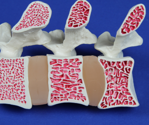 osteoporosis Osteoporosis